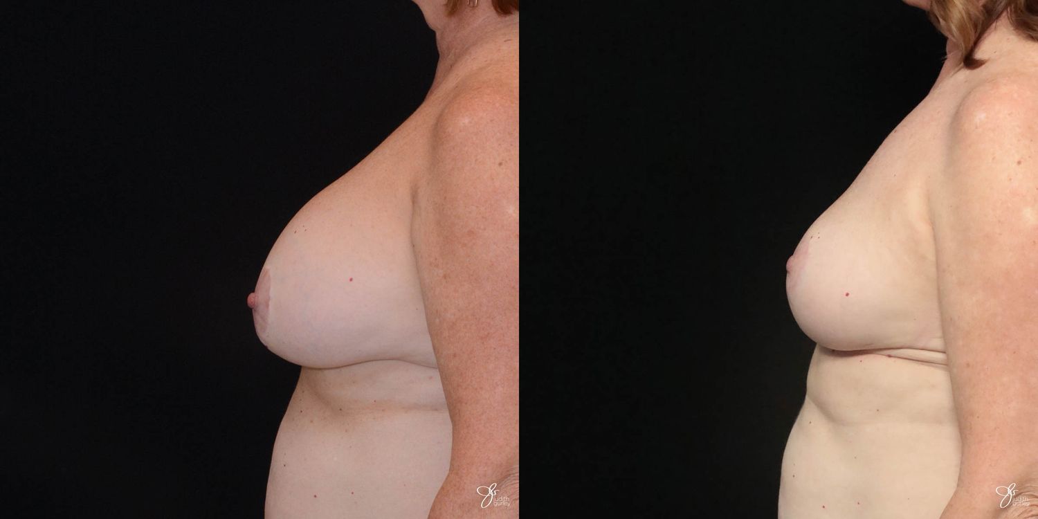 Breast Implant Removal With Lift Before & After