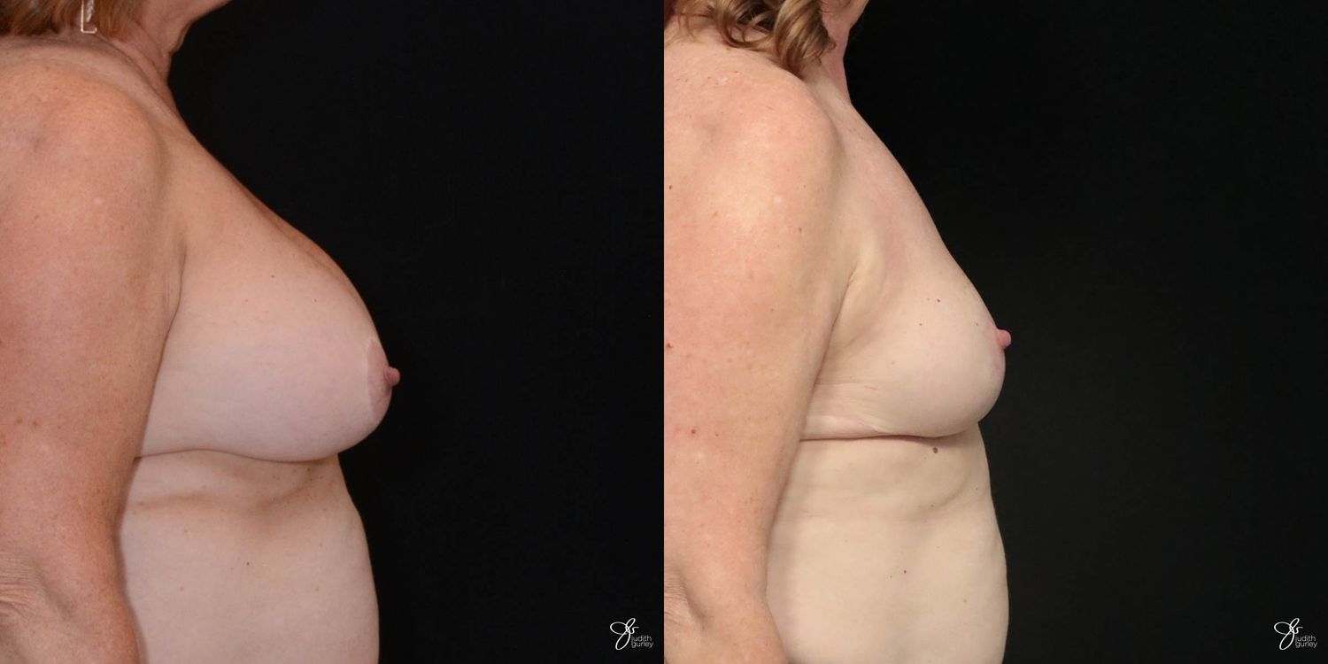 Breast Implant Removal With Lift Before & After