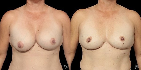 Breast Implant Removal With Lift Before & After