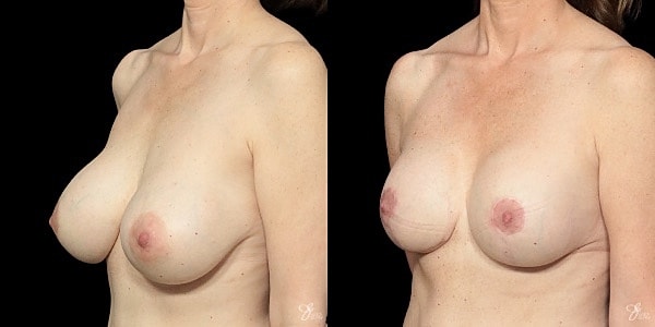 Breast Implant Removal With Lift Before & After