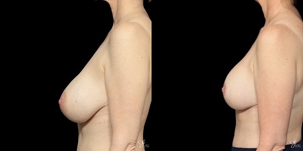 Breast Implant Removal With Lift Before & After