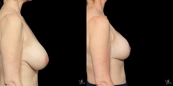 Breast Implant Removal With Lift Before & After