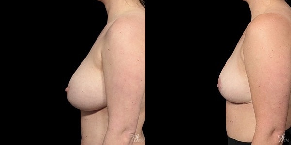 Breast Implant Removal With Lift Before & After