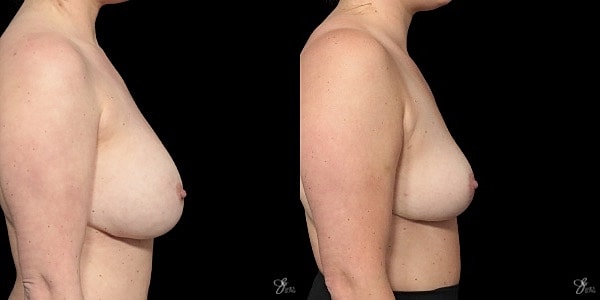 Breast Implant Removal With Lift Before & After