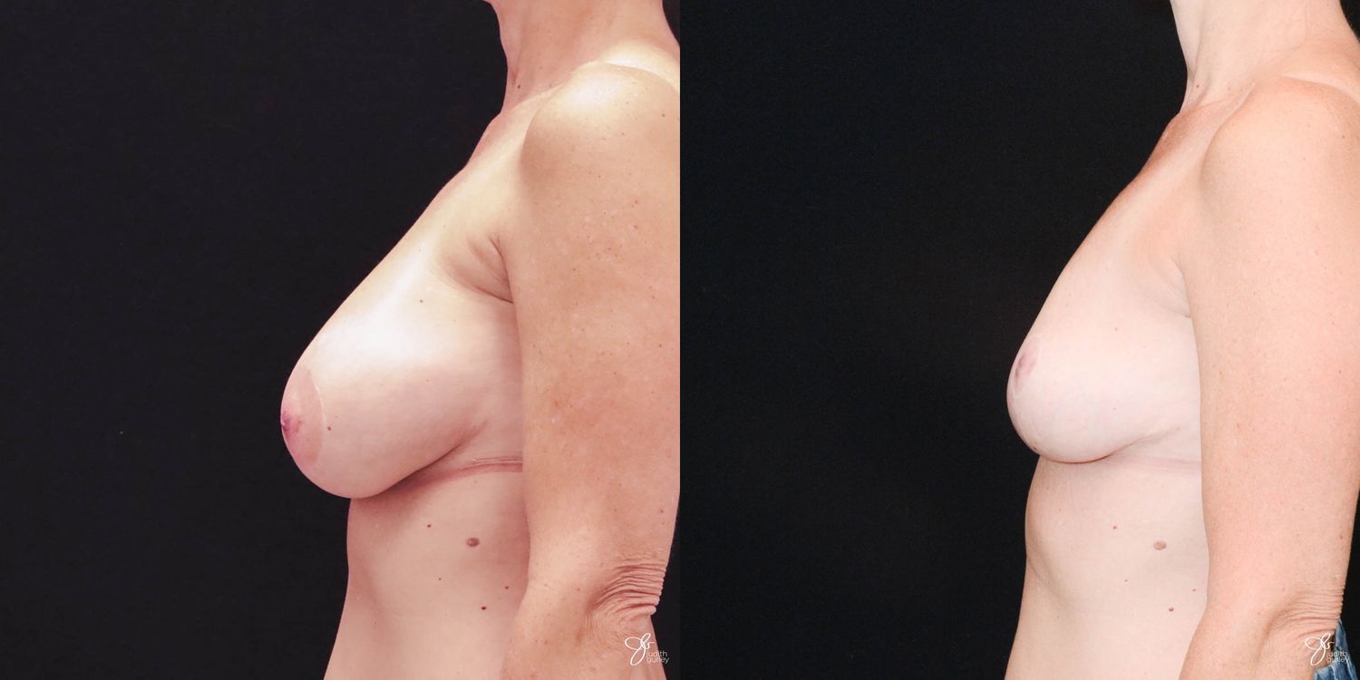 Breast Implant Removal With Lift Before & After