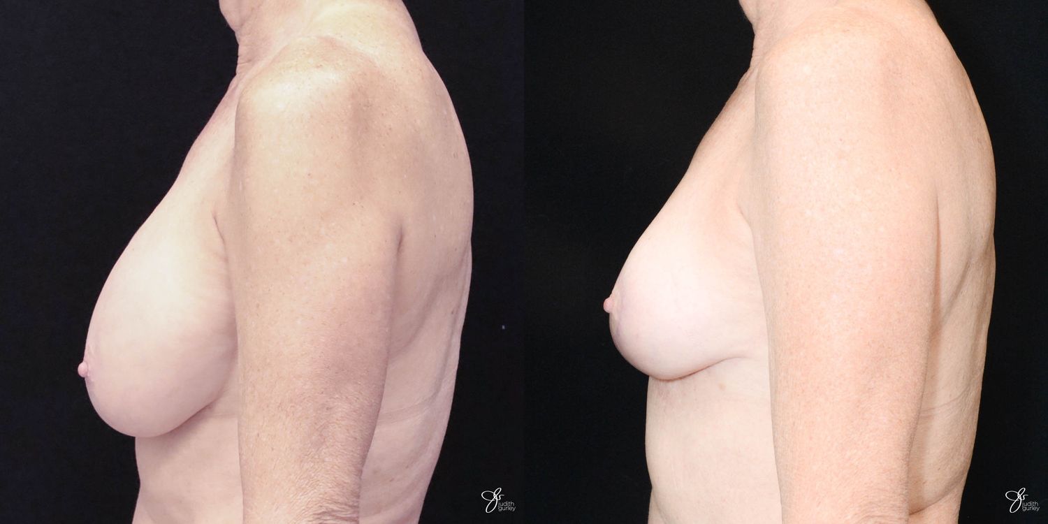 Breast Implant Removal With Lift Before & After