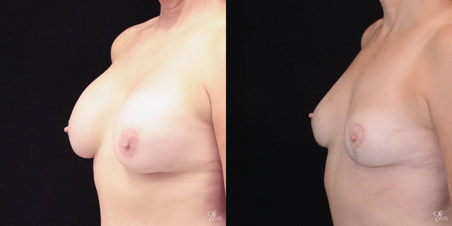 Breast Implant Removal With Lift Before & After