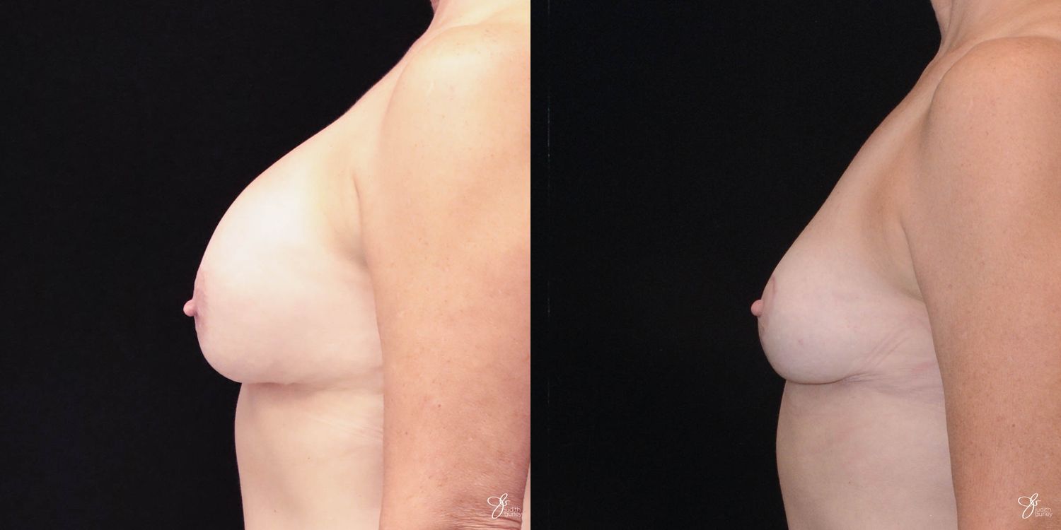 Breast Implant Removal With Lift Before & After
