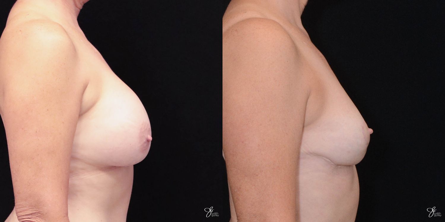 Breast Implant Removal With Lift Before & After