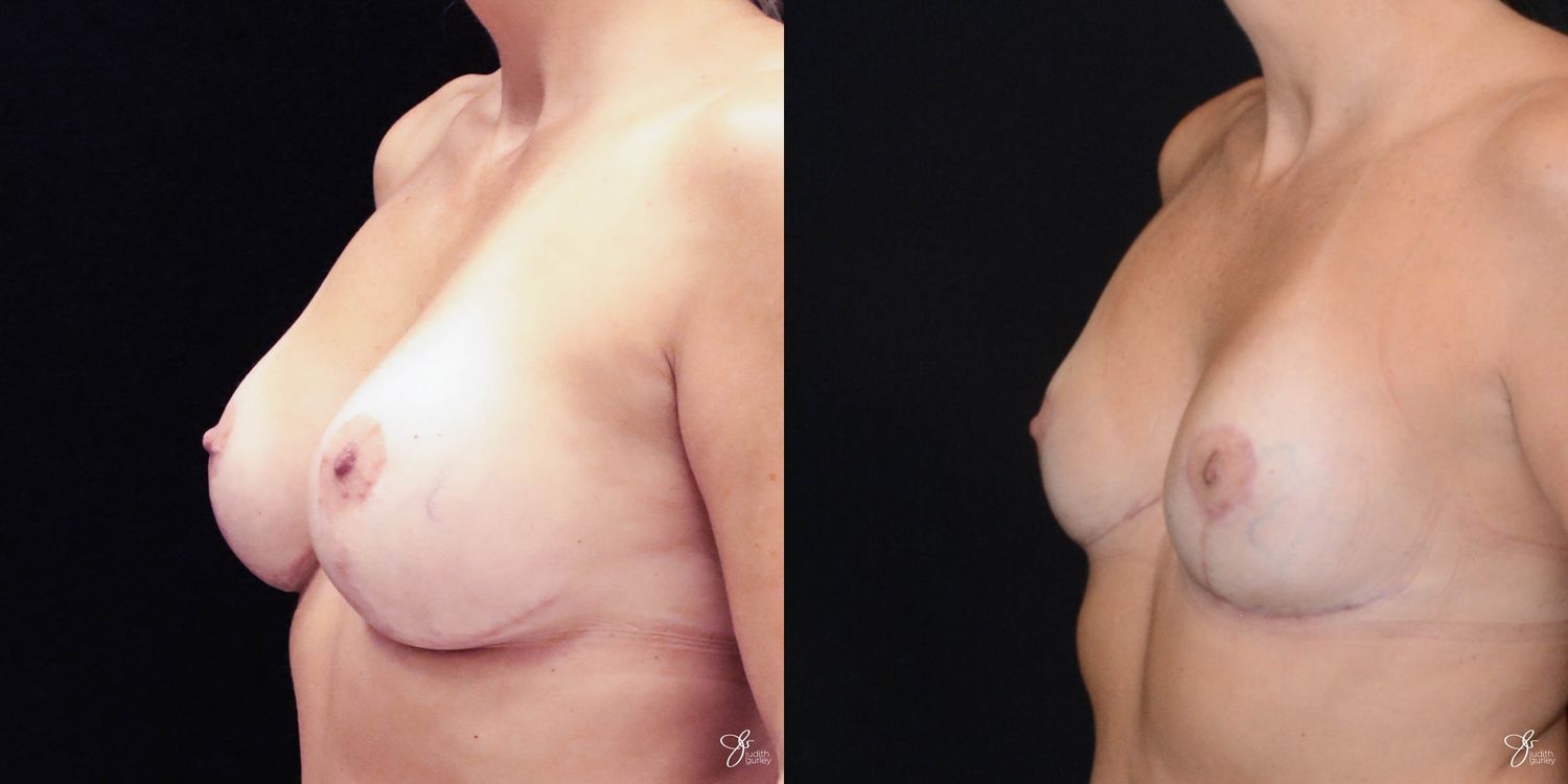 Breast Implant Removal With Lift Before & After
