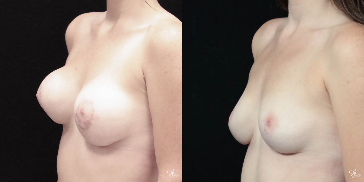 Breast Implant Removal With Lift Before & After