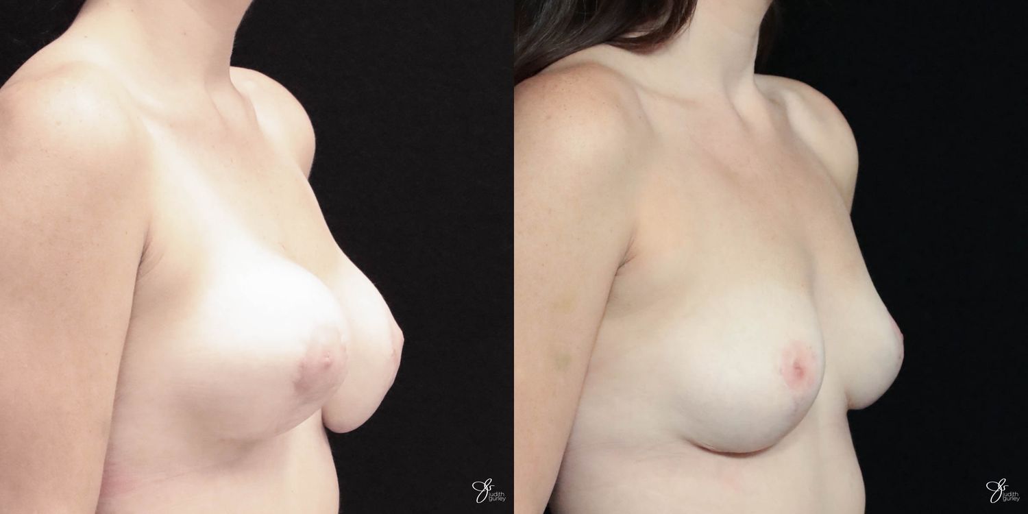 Breast Implant Removal With Lift Before & After