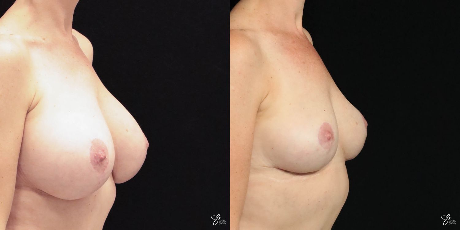 Breast Implant Removal With Lift Before & After