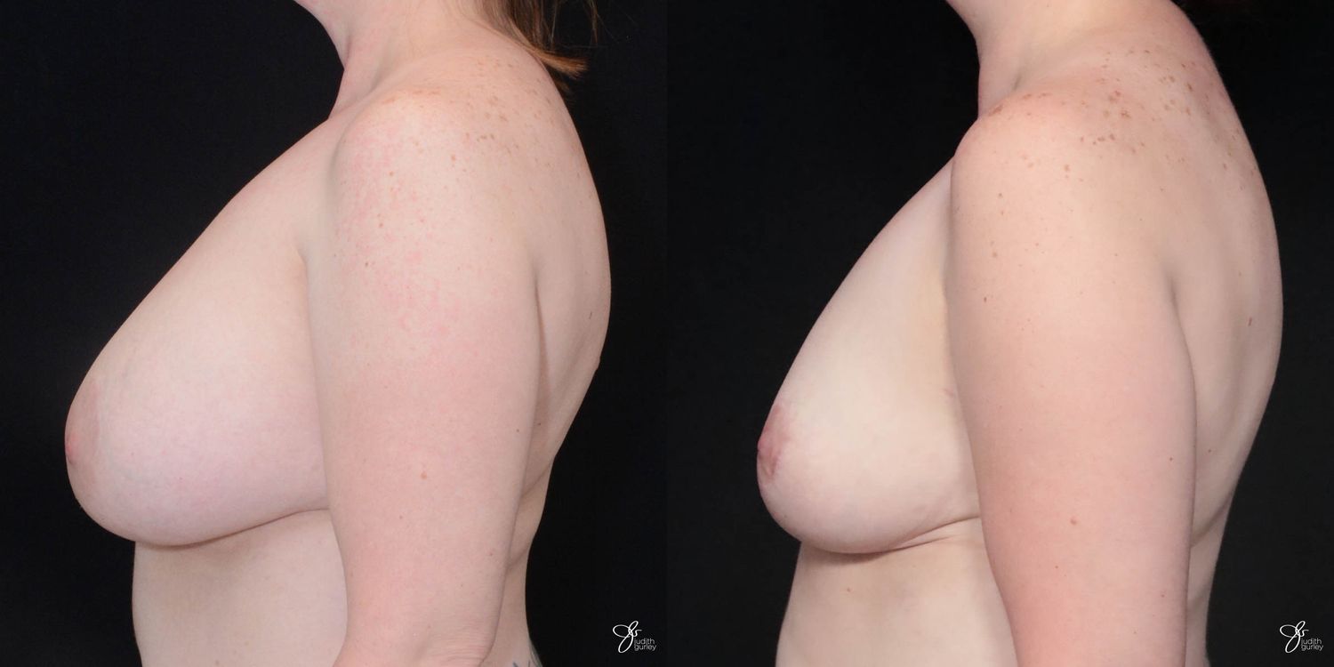 Breast Implant Removal With Lift Before & After