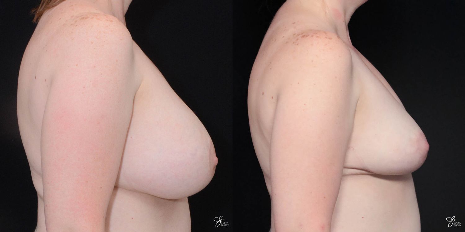 Breast Implant Removal With Lift Before & After