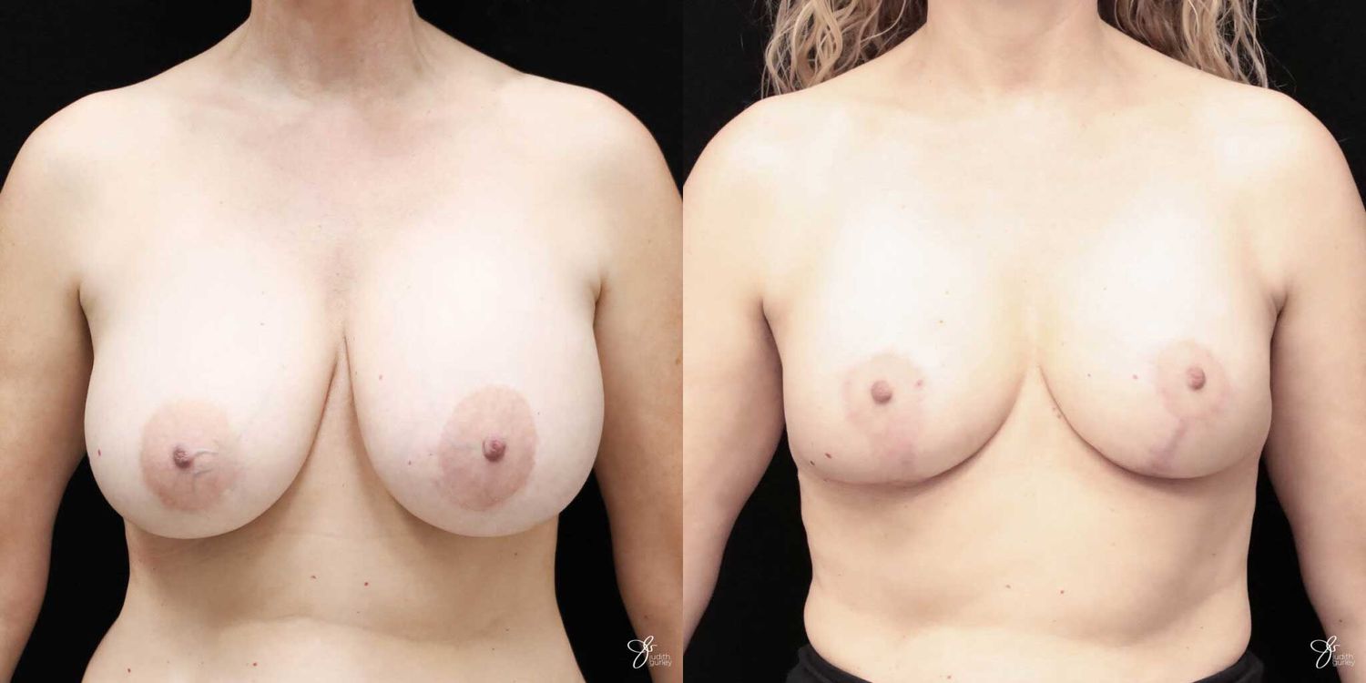 Breast Implant Removal With Lift Before & After
