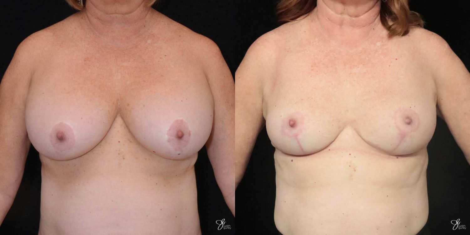 Breast Implant Removal With Lift Before & After