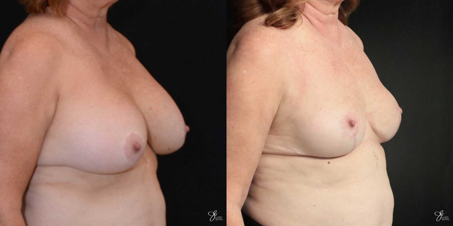 Breast Implant Removal With Lift Before & After