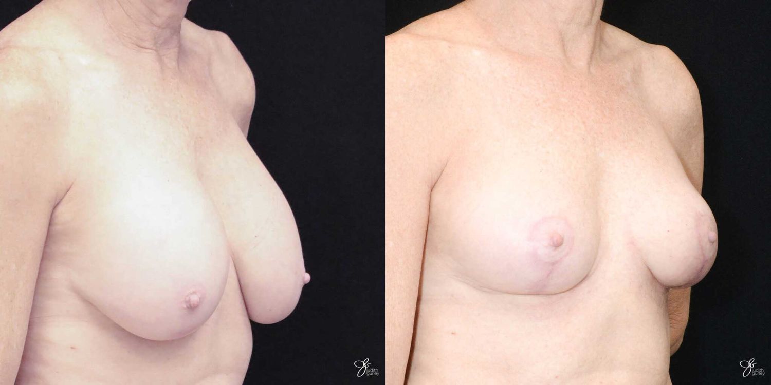 Breast Implant Removal With Lift Before & After