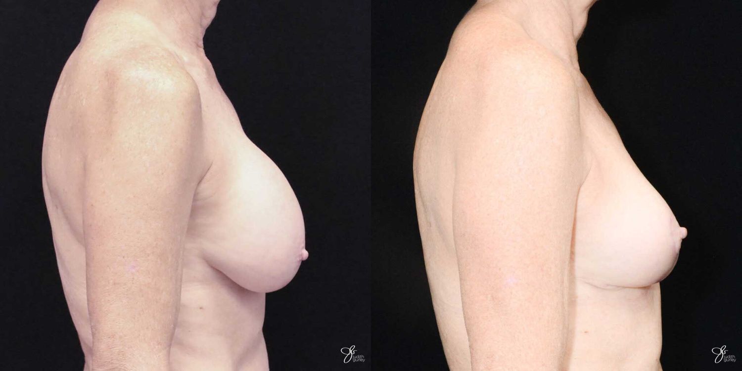 Breast Implant Removal With Lift Before & After