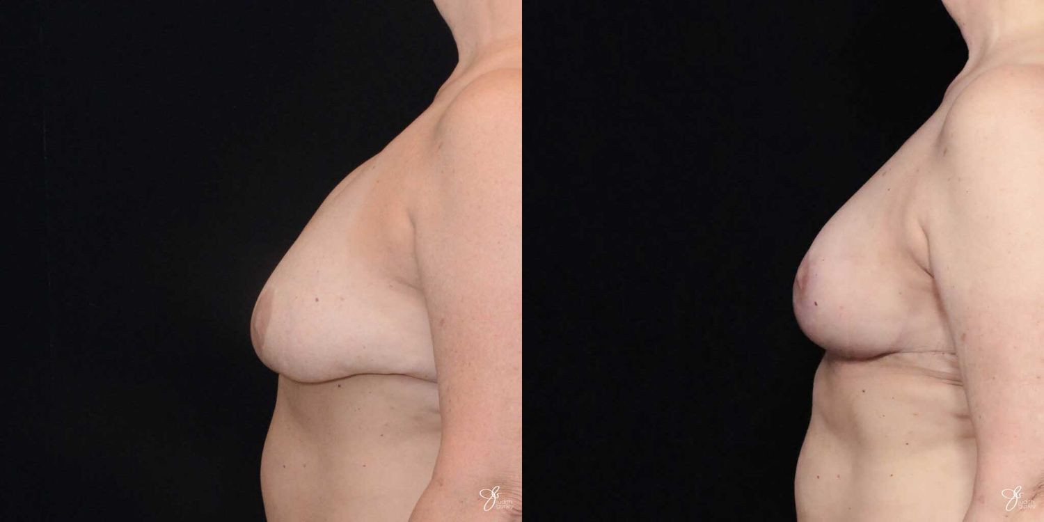 Breast Implant Removal With Lift Before & After