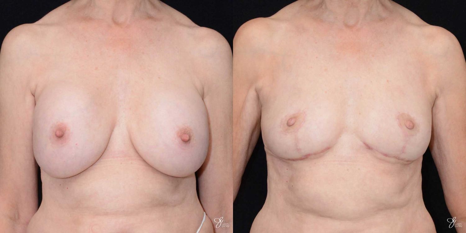 Breast Implant Removal With Lift Before & After