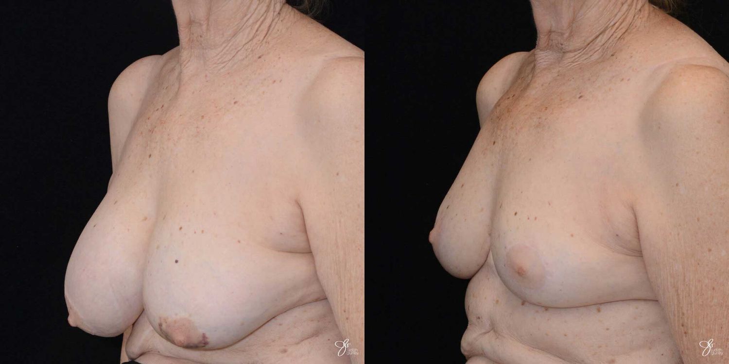 Breast Implant Removal With Lift Before & After