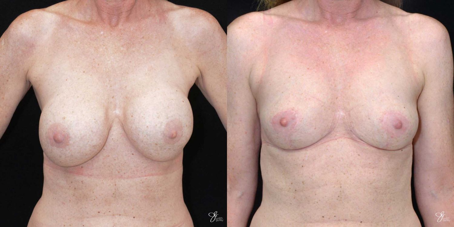 Breast Implant Removal With Lift Before & After