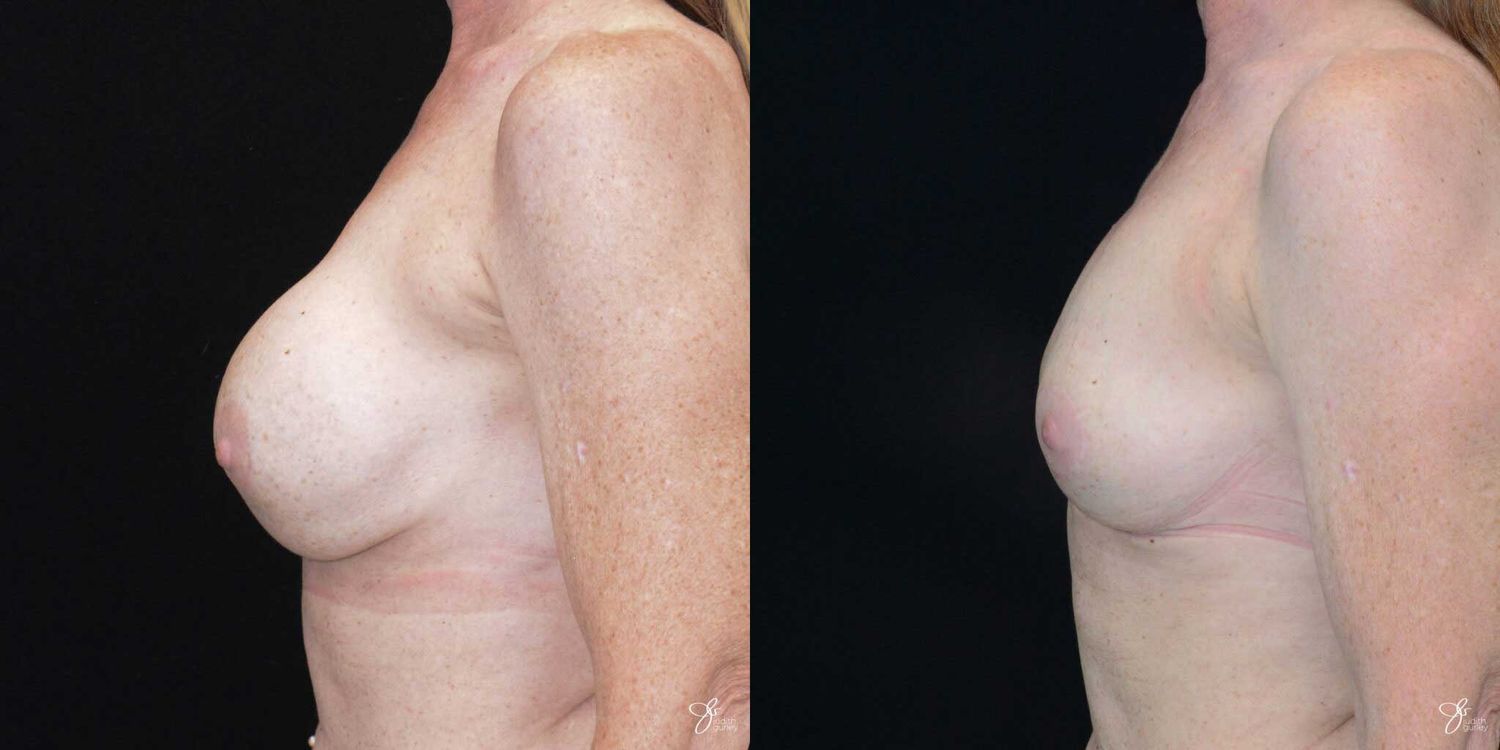 Breast Implant Removal With Lift Before & After