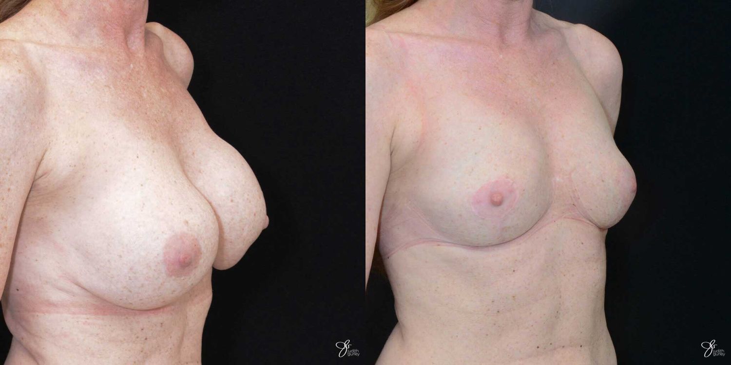 Breast Implant Removal With Lift Before & After