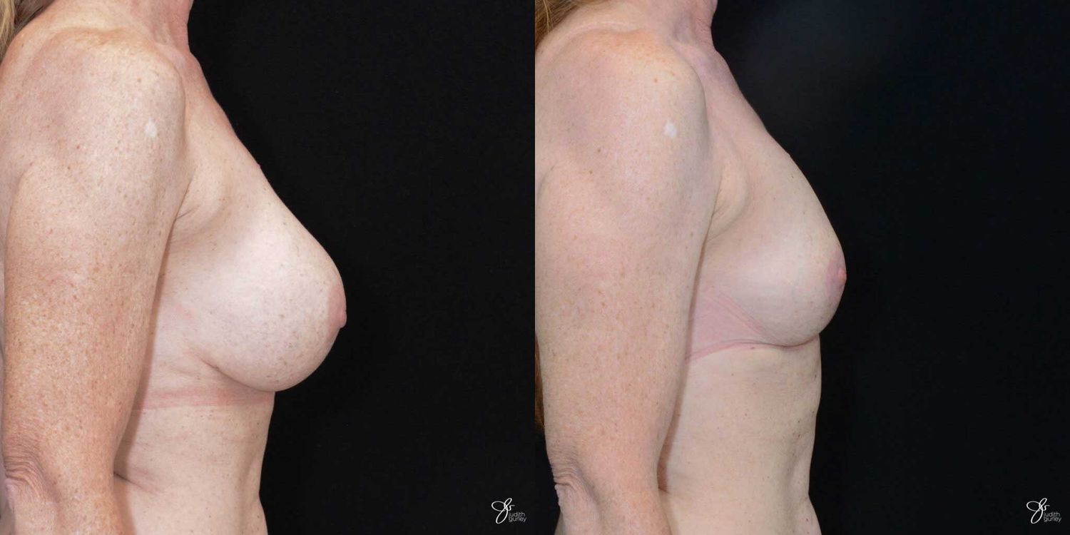 Breast Implant Removal With Lift Before & After