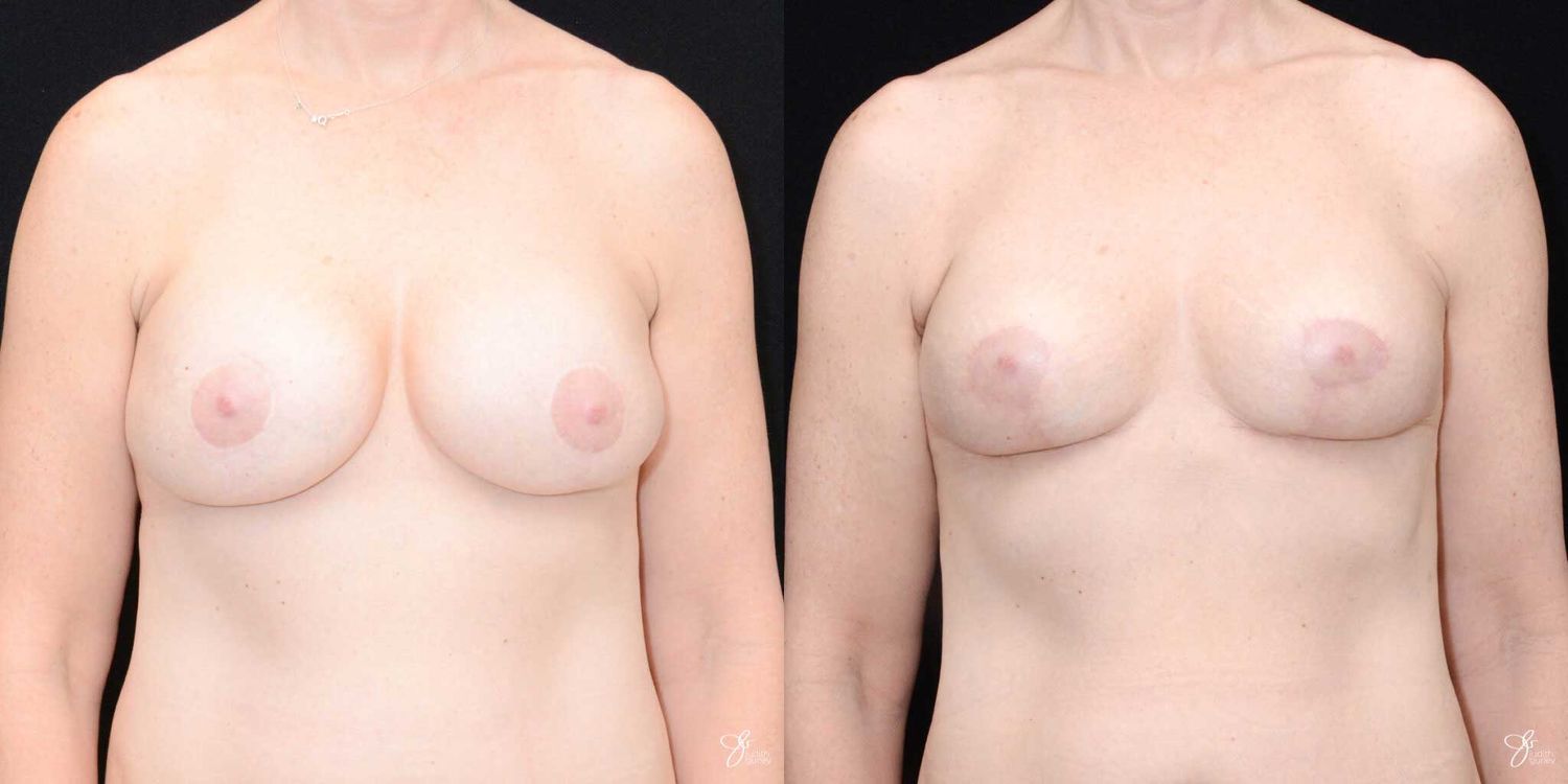 Breast Implant Removal With Lift Before & After