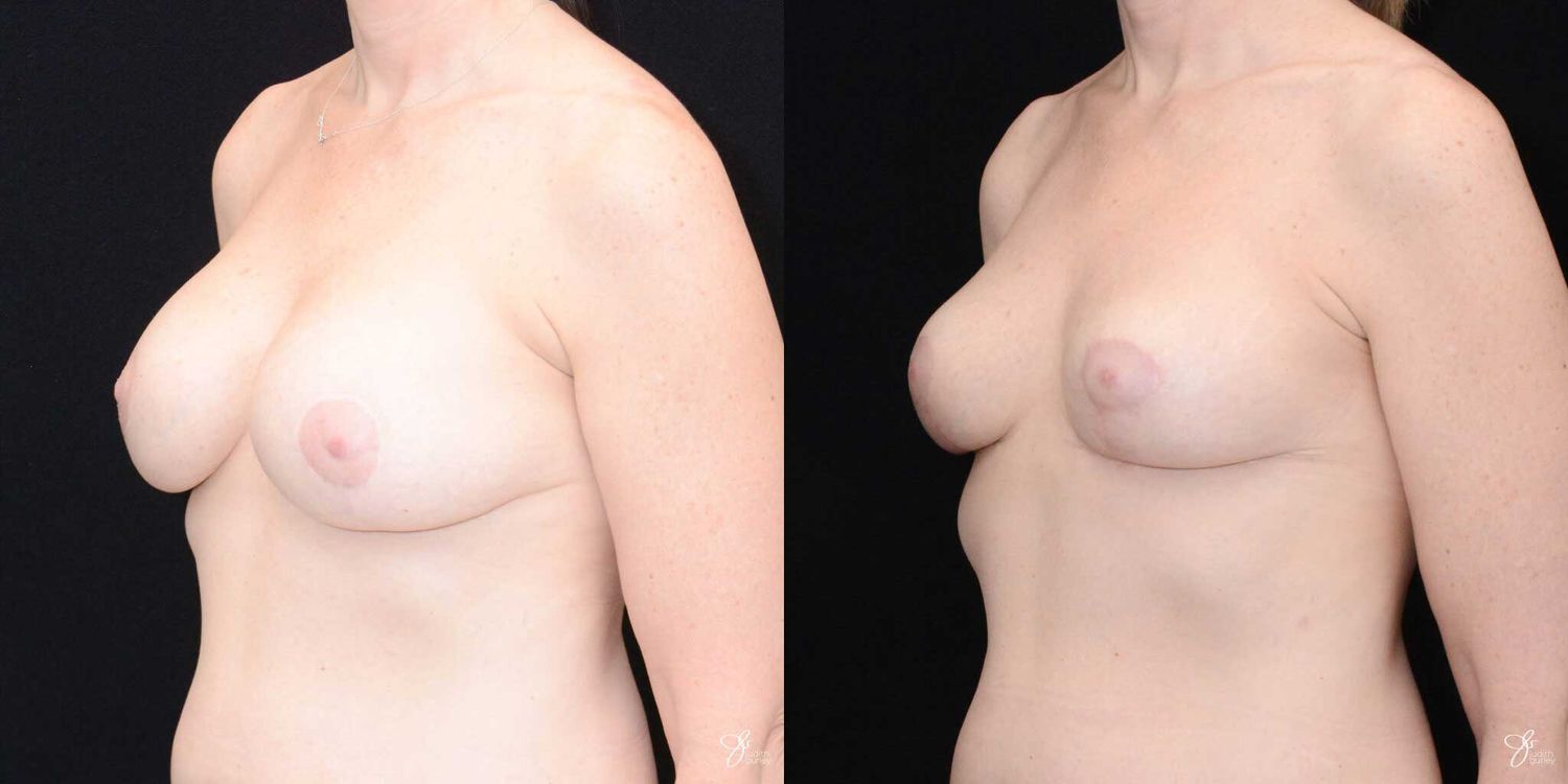 Breast Implant Removal With Lift Before & After