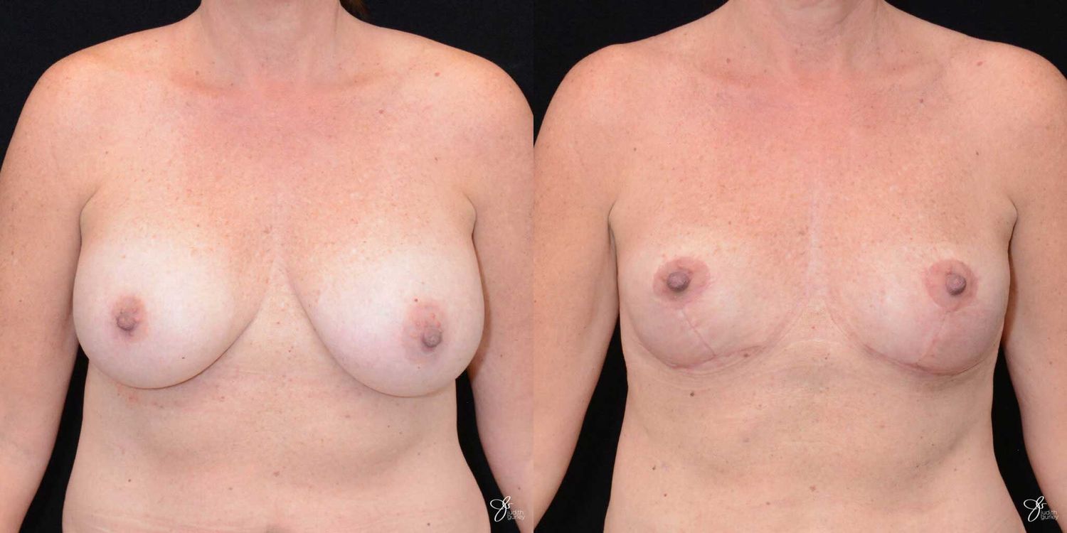 Breast Implant Removal With Lift Before & After