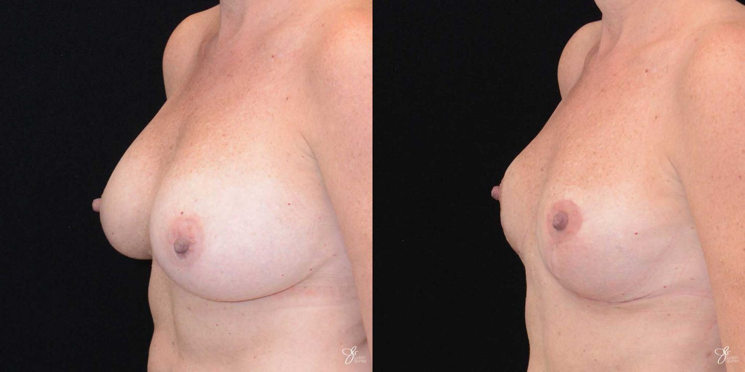 Breast Implant Removal With Lift Before & After