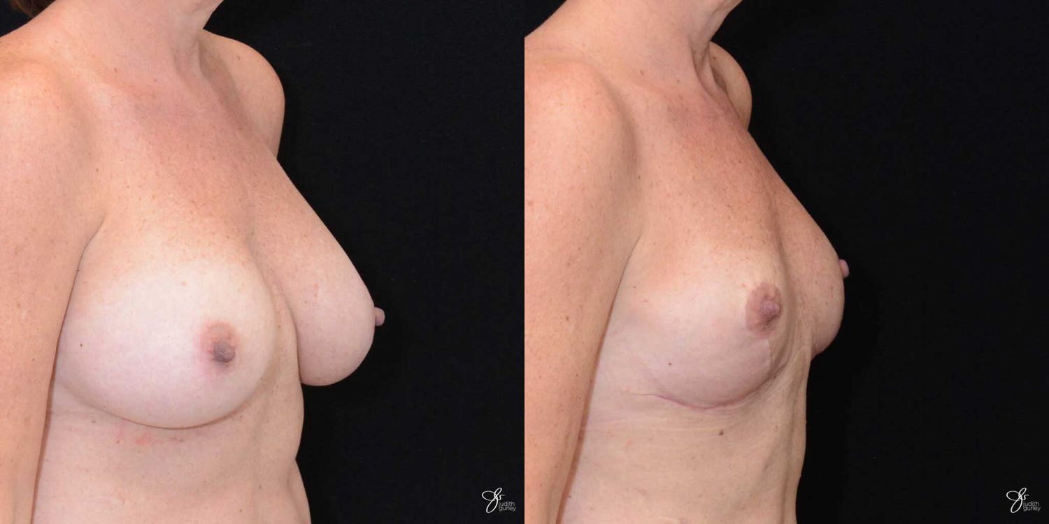 Breast Implant Removal With Lift Before & After