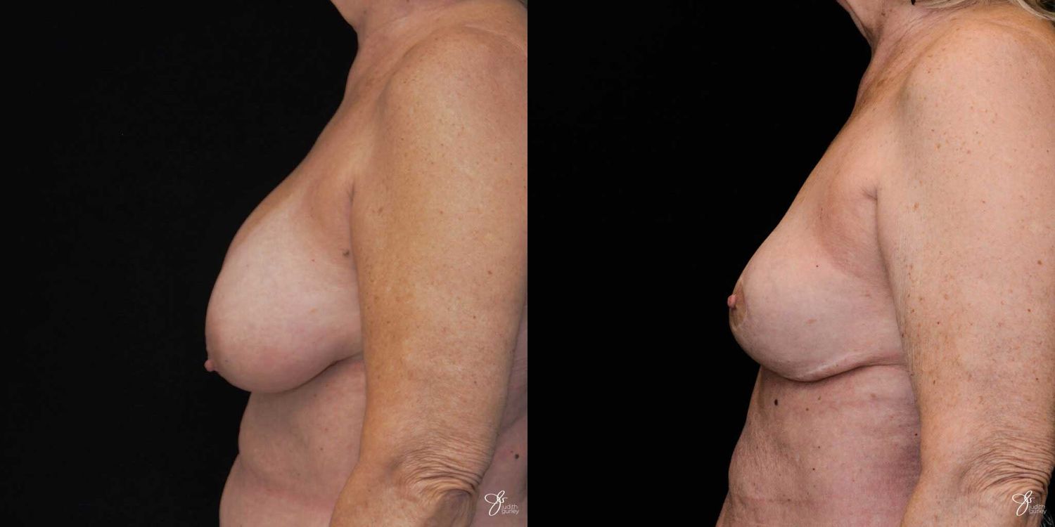 Breast Implant Removal With Lift Before & After
