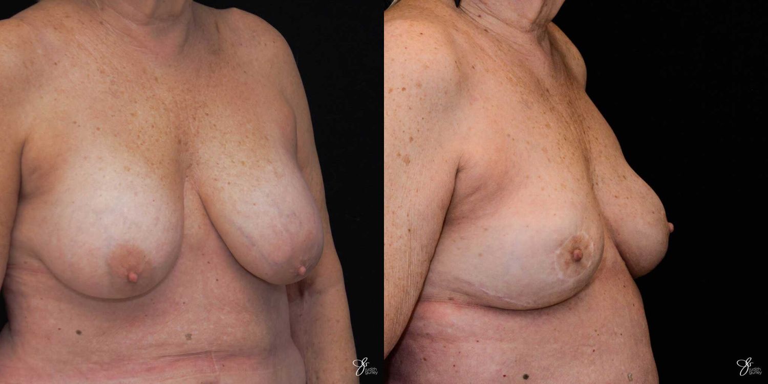 Breast Implant Removal With Lift Before & After