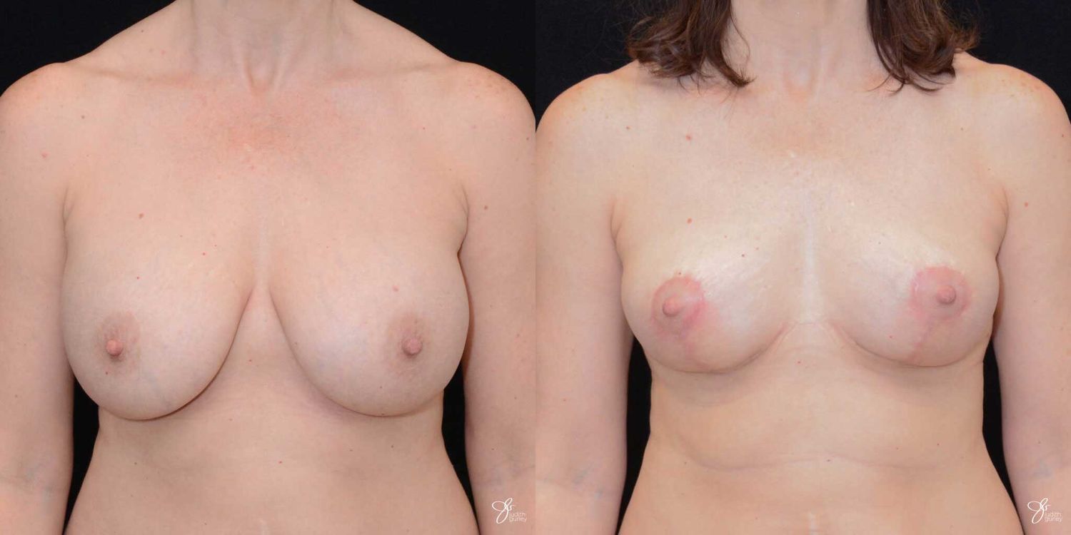 Breast Implant Removal With Lift Before & After