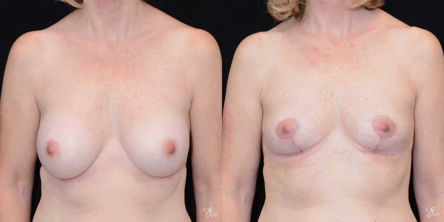 Breast Implant Removal With Lift Before & After