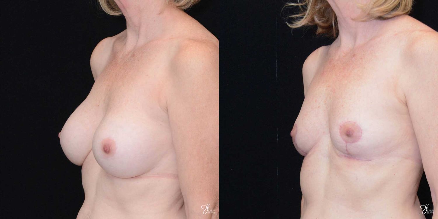 Breast Implant Removal With Lift Before & After