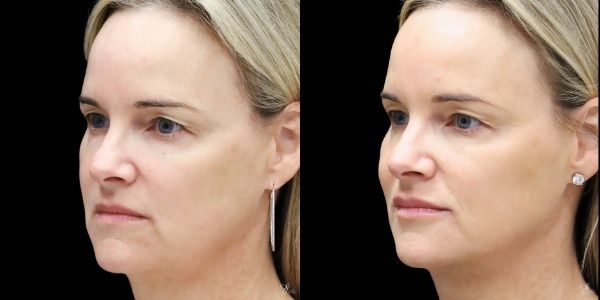 Facial Filler Before & After