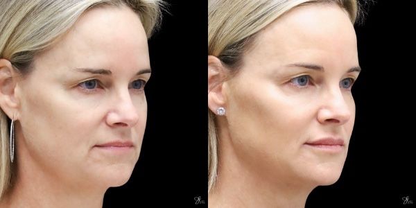 Facial Filler Before & After