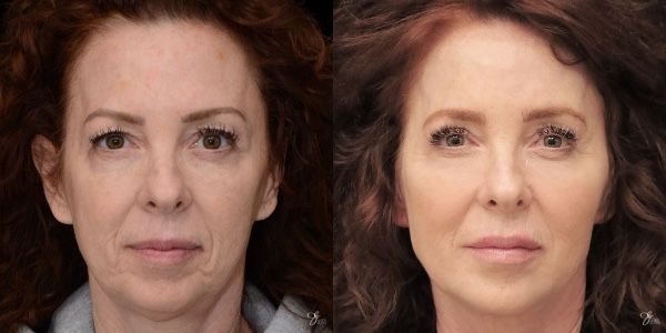 Facial Filler Before & After