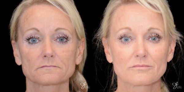 Facial Filler Before & After