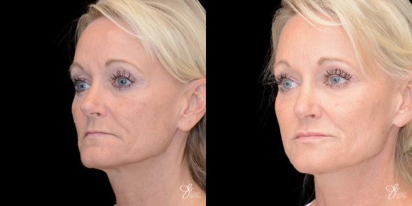 Facial Filler Before & After