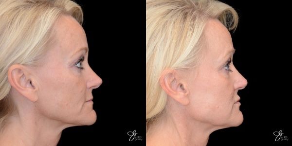 Facial Filler Before & After