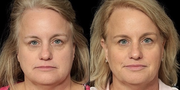 Facial Filler Before & After