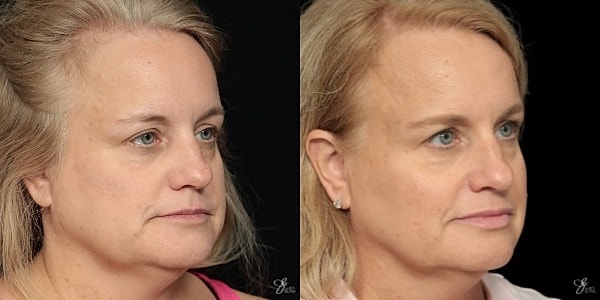 Facial Filler Before & After