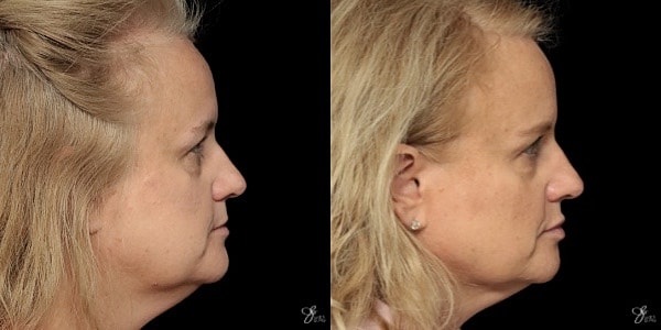 Facial Filler Before & After